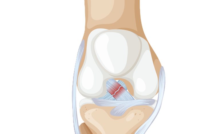 Ligamento cruzado anterior (LCA)