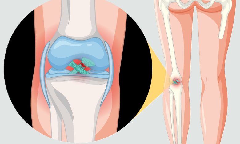 Ligamento cruzado posterior (LCP)