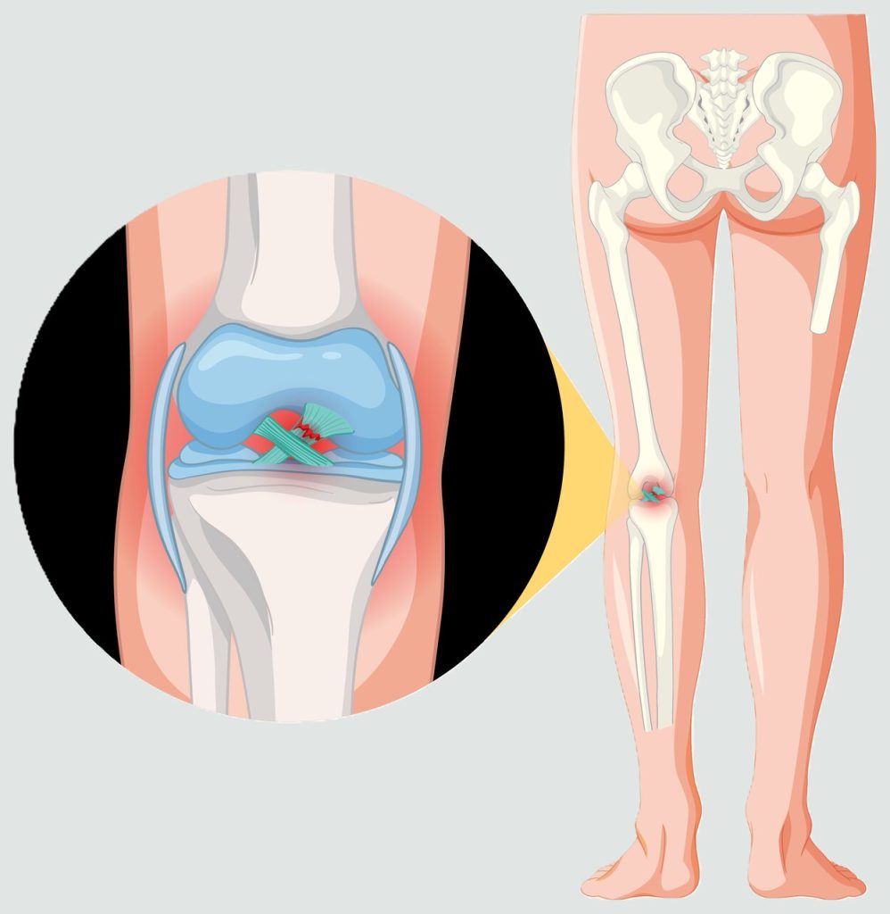 Ligamento cruzado posterior (LCP)