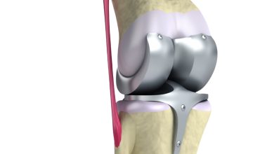 Prótese total de joelho: quando esse tratamento é indicado?
