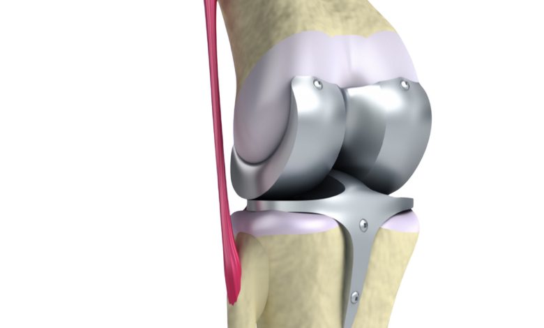 Prótese total de joelho: quando esse tratamento é indicado?