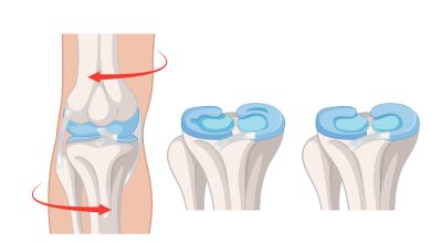 Dor, estalos e travamento no joelho? Pode ser lesão no menisco
