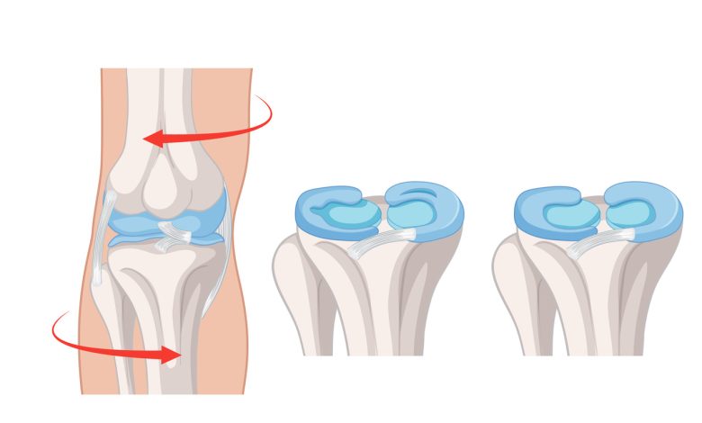 Dor, estalos e travamento no joelho? Pode ser lesão no menisco