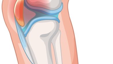 Dor na frente do joelho? Pode ser condropatia patelar