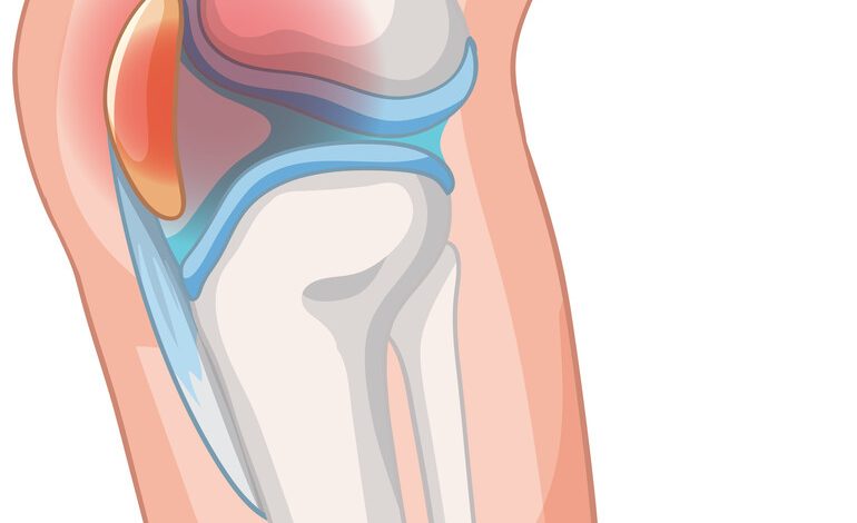 Dor na frente do joelho? Pode ser condropatia patelar