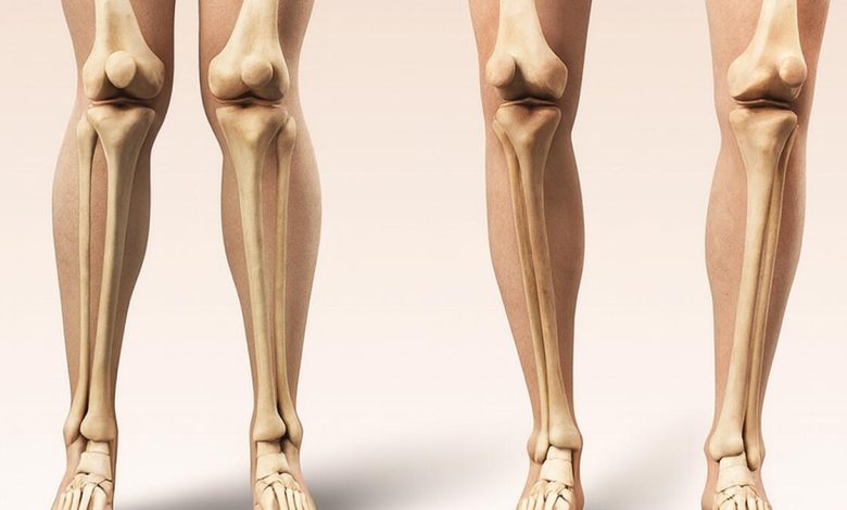 Seus joelhos estão alinhados. Veja o que o formato das suas pernas pode revelar