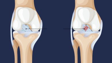 Lesão do LCA o problema que pode estar no seu joelho sem você saber