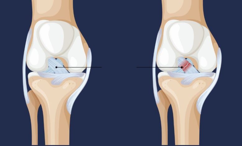 Lesão do LCA o problema que pode estar no seu joelho sem você saber