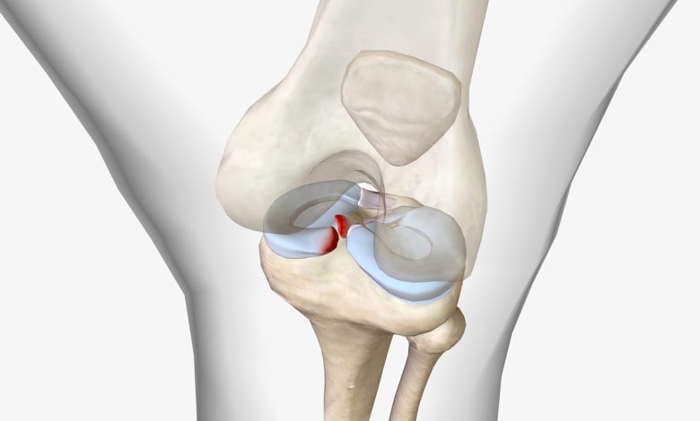 Lesionei o menisco É melhor reparar ou remover