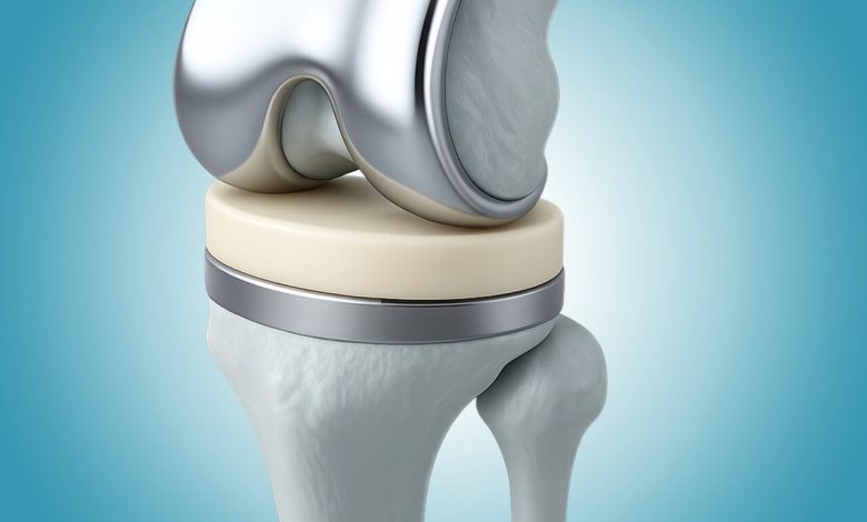 Tudo o que te contaram sobre a prótese de joelho